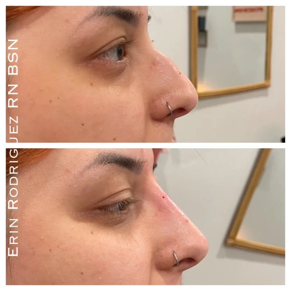 Before and After treatment on Nose image of Golden Medical Aesthetics in Meridian, ID