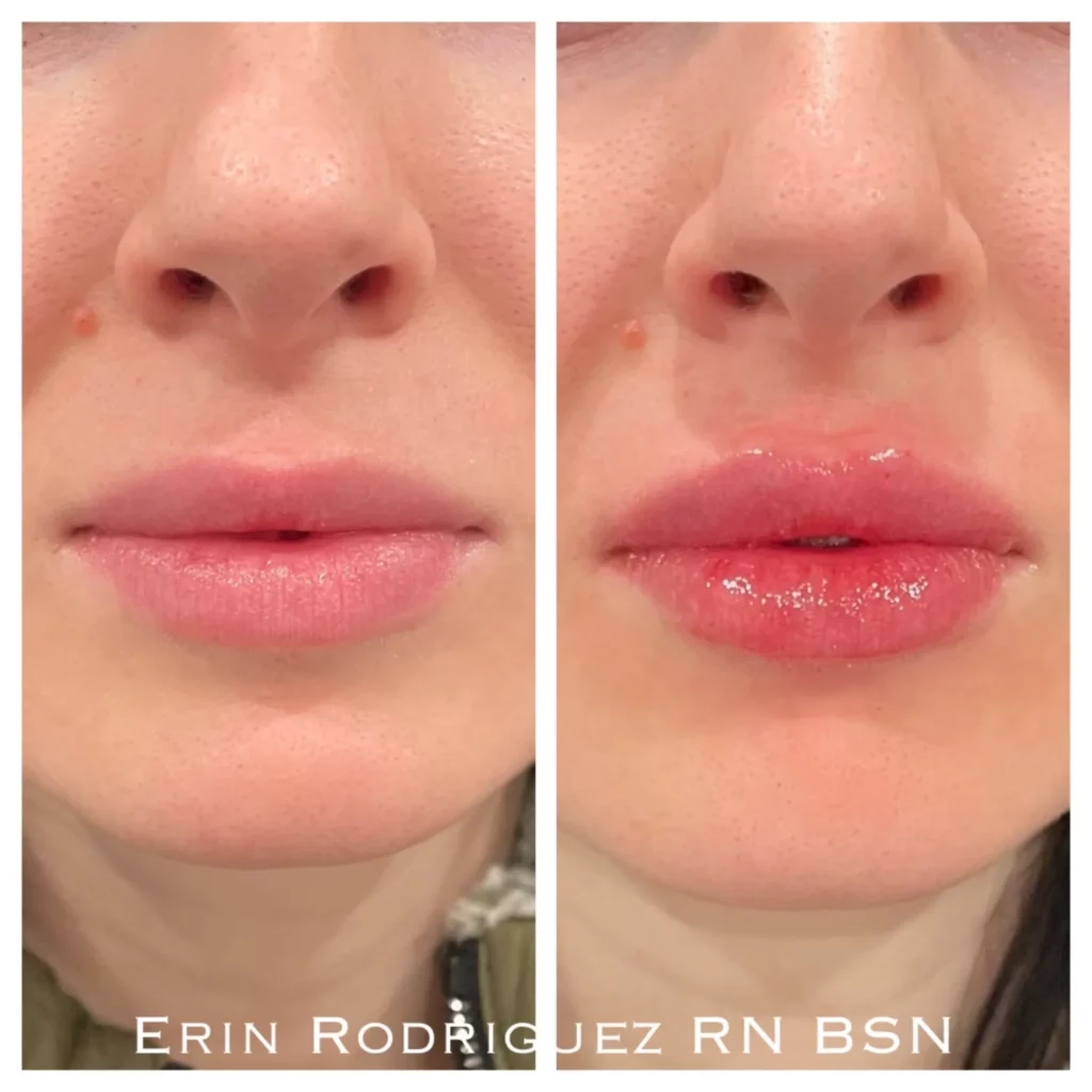 Before and After Lips filler treatment image of Golden Medical Aesthetics in Meridian, ID