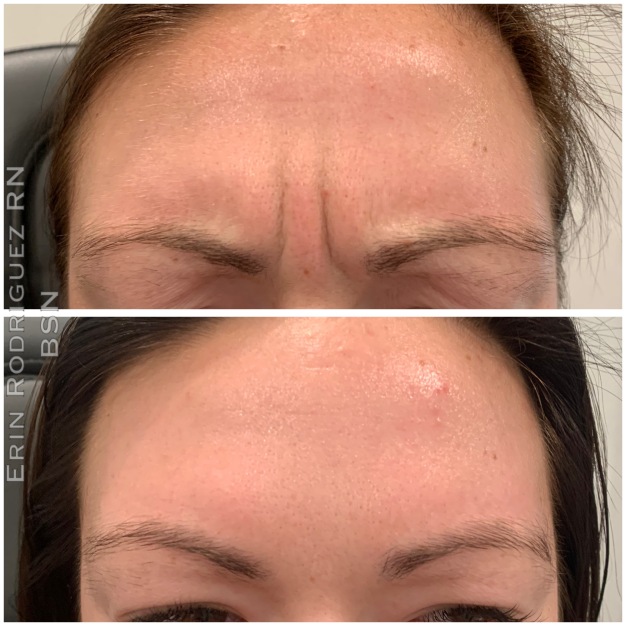 Before and After Forehead Wrinkle treatment image of Golden Medical Aesthetics in Meridian, ID