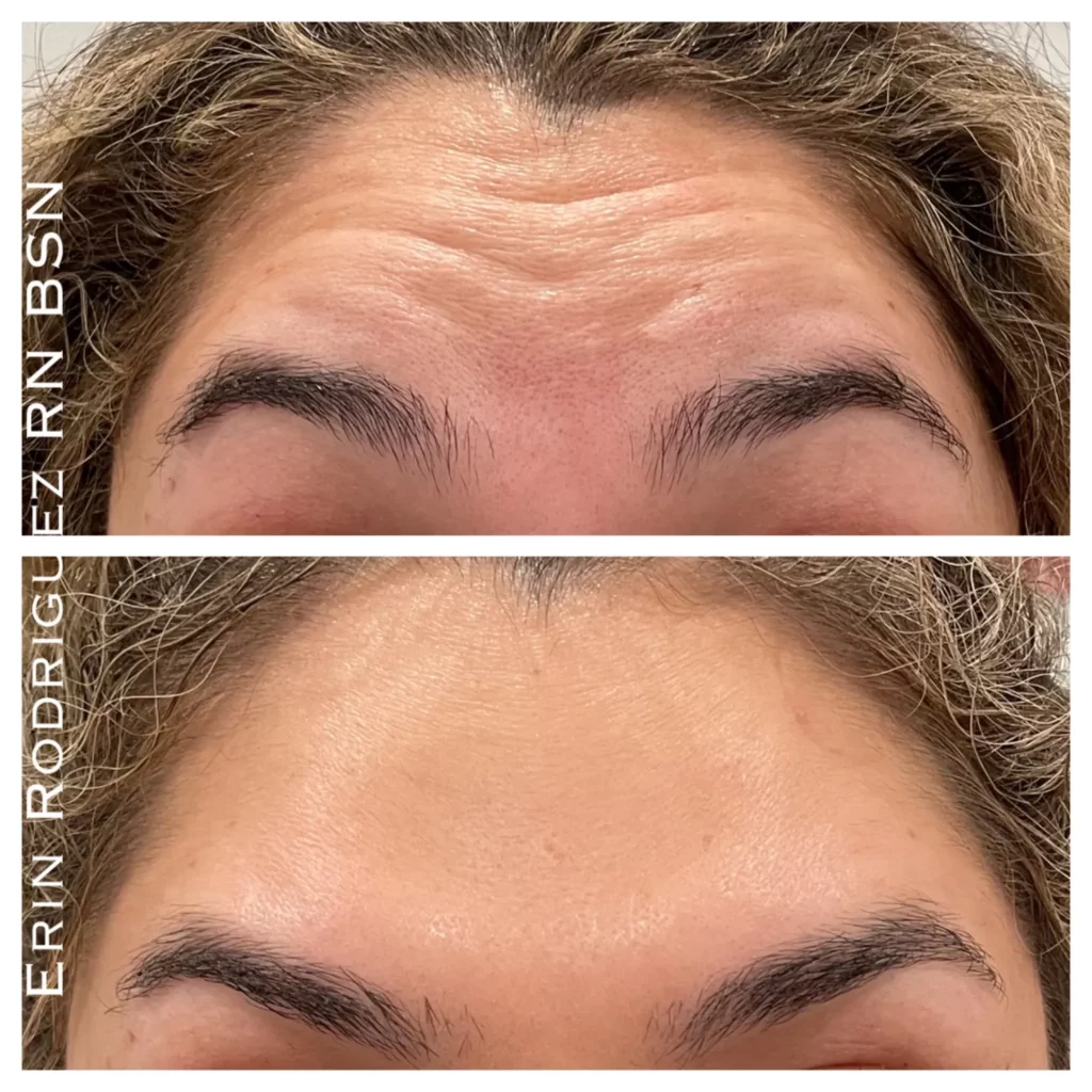 Before and After Forehead Wrinkle treatment image of Golden Medical Aesthetics in Meridian, ID