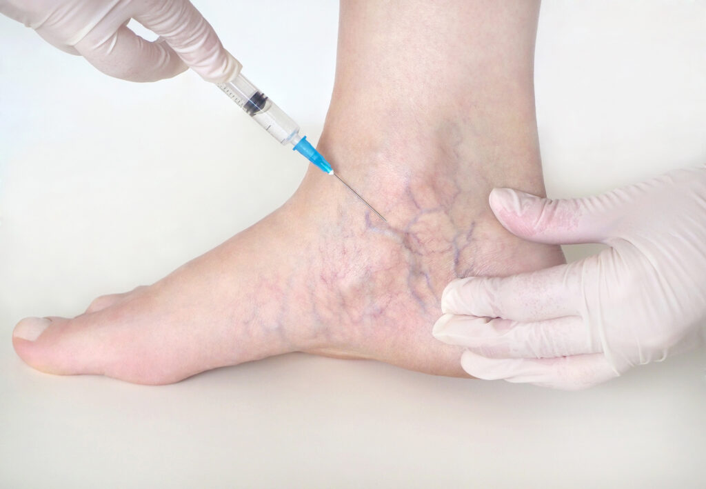 Portrait of Injection on Spider veins on leg | Golden Medical Aesthetics in Meridian, ID
