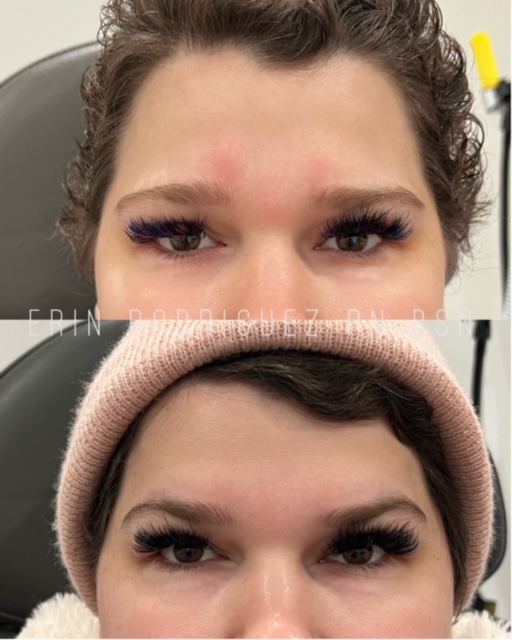 Before and After Forehead Wrinkle treatment images of Golden Medical Aesthetics in Meridian, ID