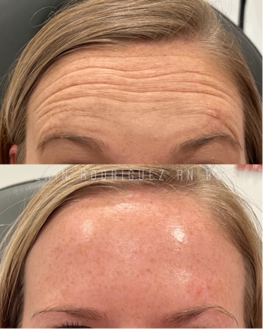 Before and After Forehead Wrinkle treatment images of Golden Medical Aesthetics in Meridian, ID