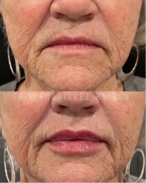 Before and After Lips treatment images of Golden Medical Aesthetics in Meridian, ID