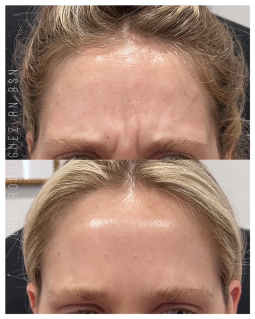 Before and After Forehead Wrinkles treatment images of Golden Medical Aesthetics in Meridian, ID