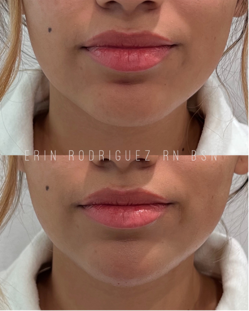 Before and After lips treatment images of Golden Medical Aesthetics in Meridian, ID
