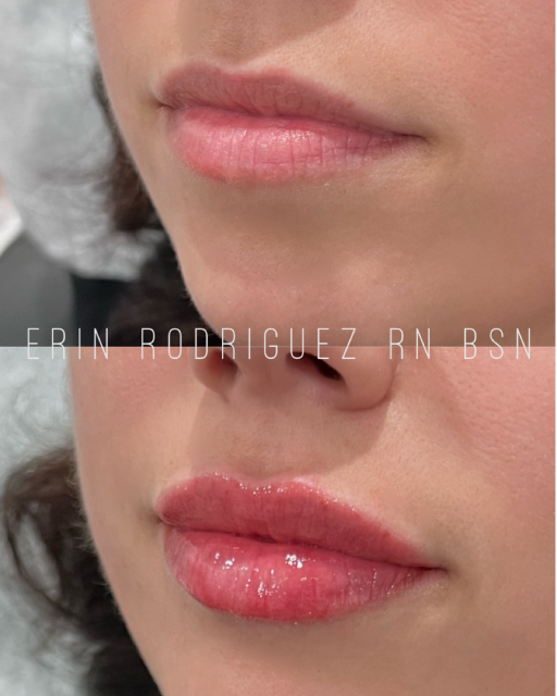 Before and After lips treatment images of Golden Medical Aesthetics in Meridian, ID