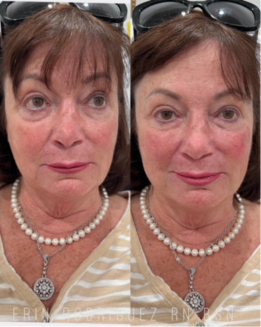 Before and After treatment images of Golden Medical Aesthetics in Meridian, ID