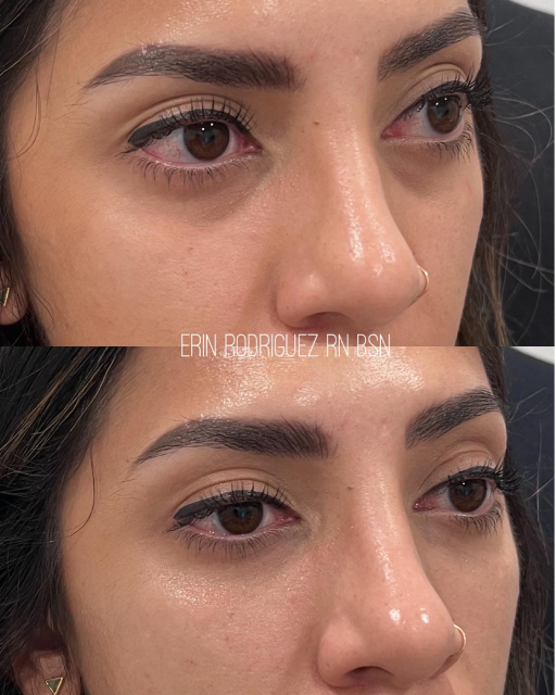 Before and After treatment images of Golden Medical Aesthetics in Meridian, ID