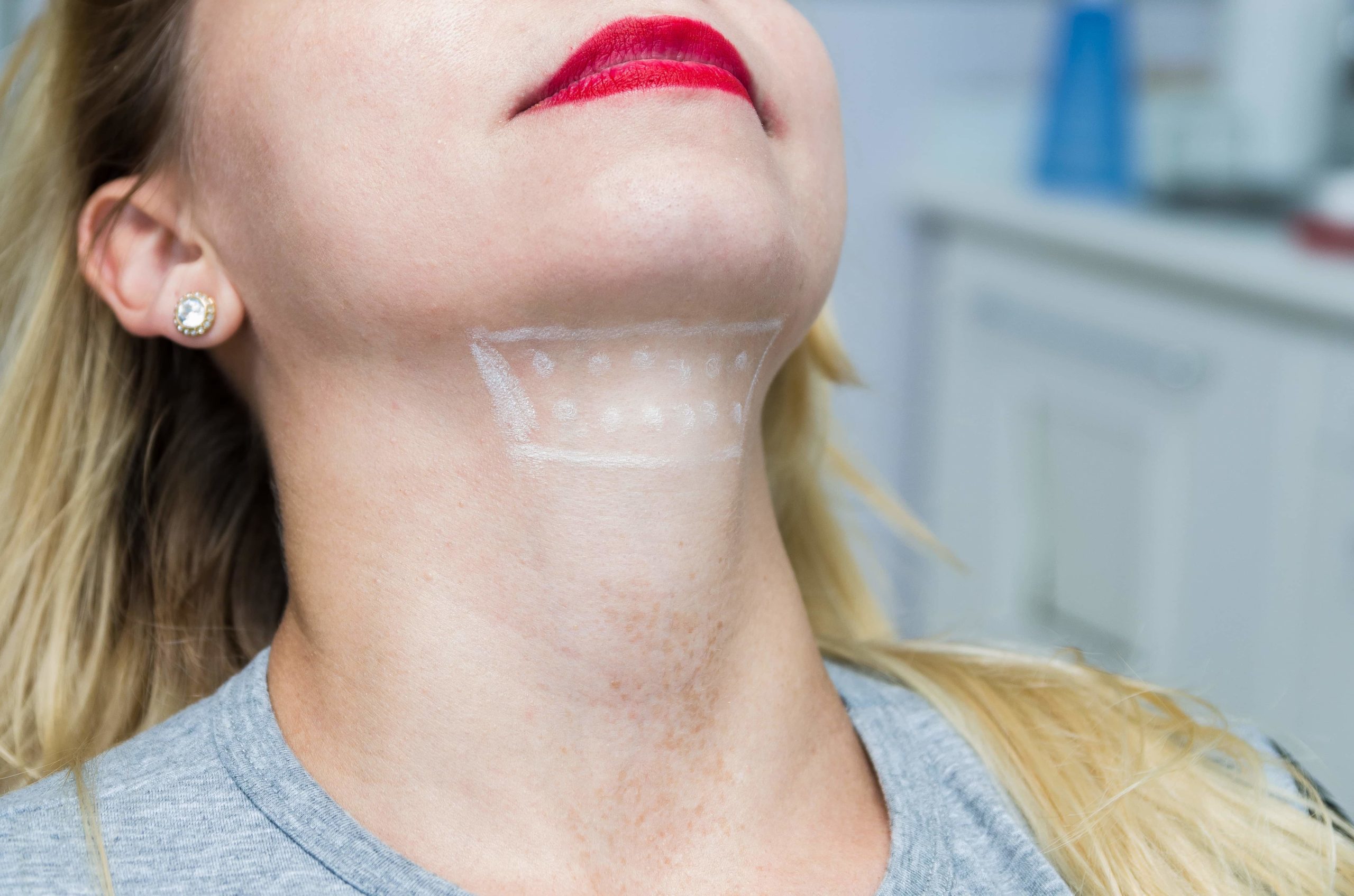 How Much Time is There Between Kybella Treatments