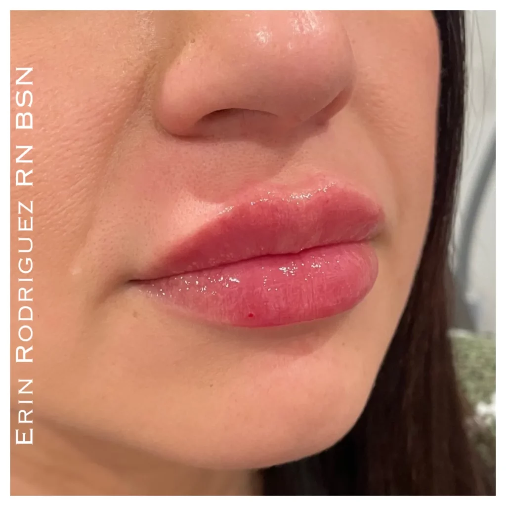 Lips filler treatment image of Golden Medical Aesthetics in Meridian, ID