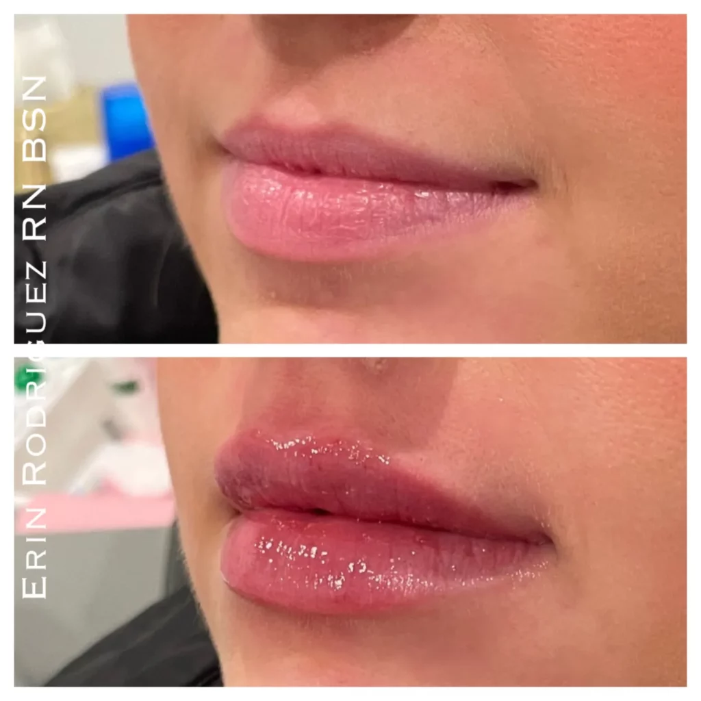 Before and After Lips filler treatment image of Golden Medical Aesthetics in Meridian, ID