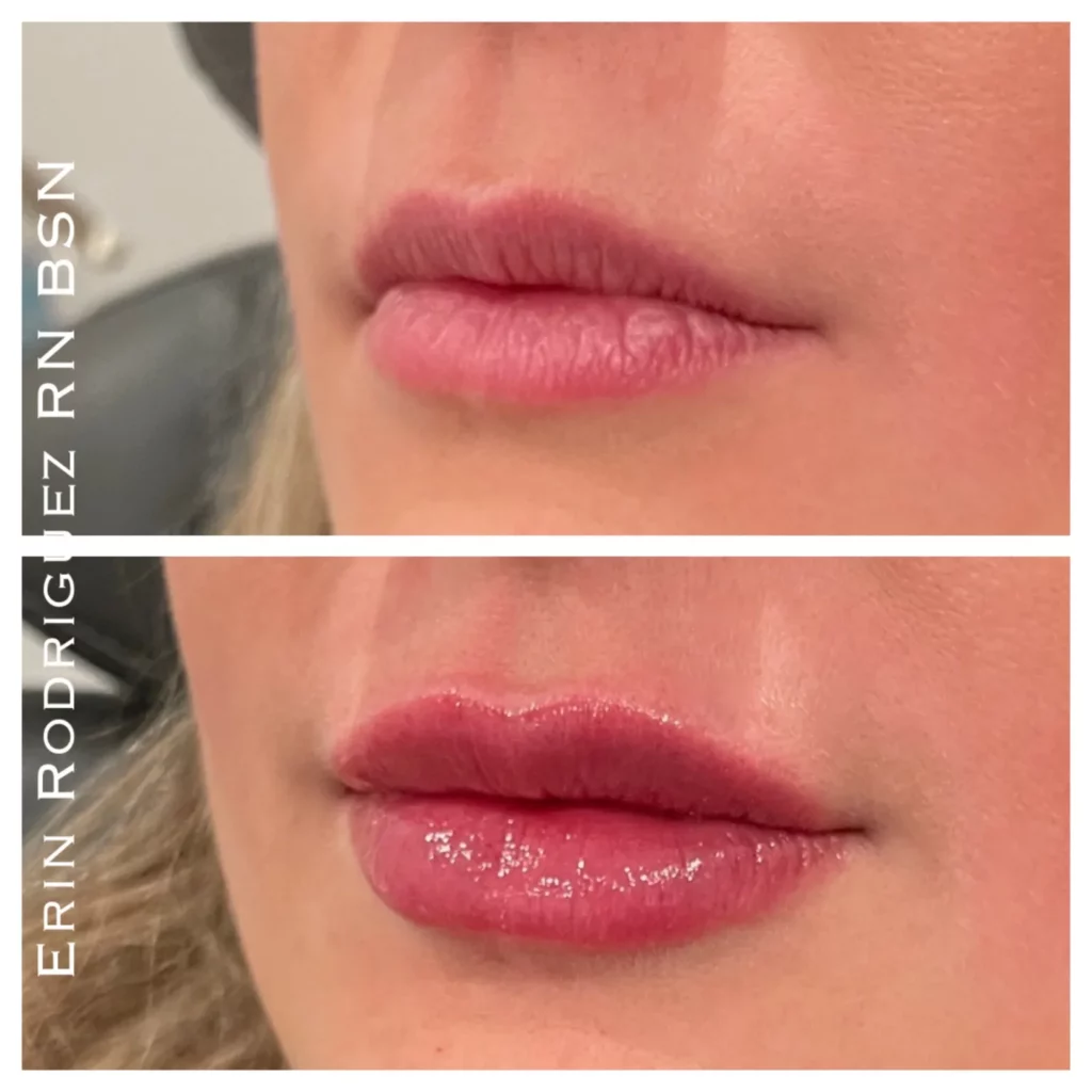 Before and After Lips filler treatment image of Golden Medical Aesthetics in Meridian, ID