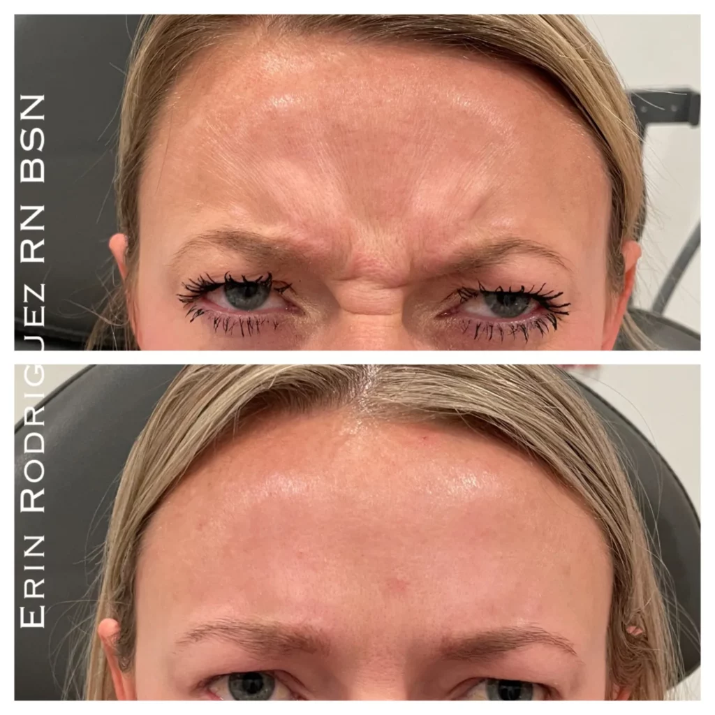 Before and After Forehead Wrinkle treatment image of Golden Medical Aesthetics in Meridian, ID