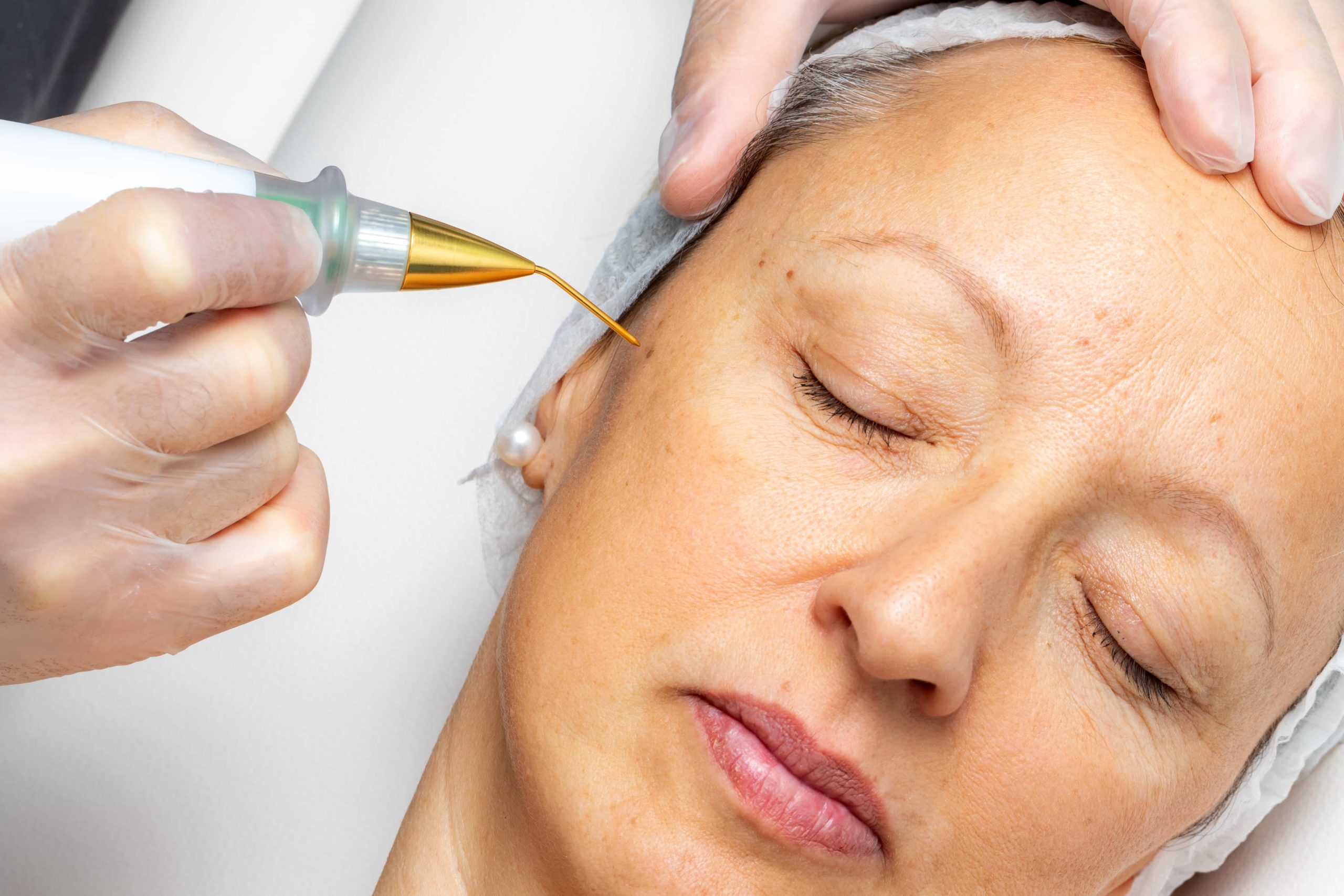 Subnovii Plasma Pen Non-Surgical Skin Rejuvenation