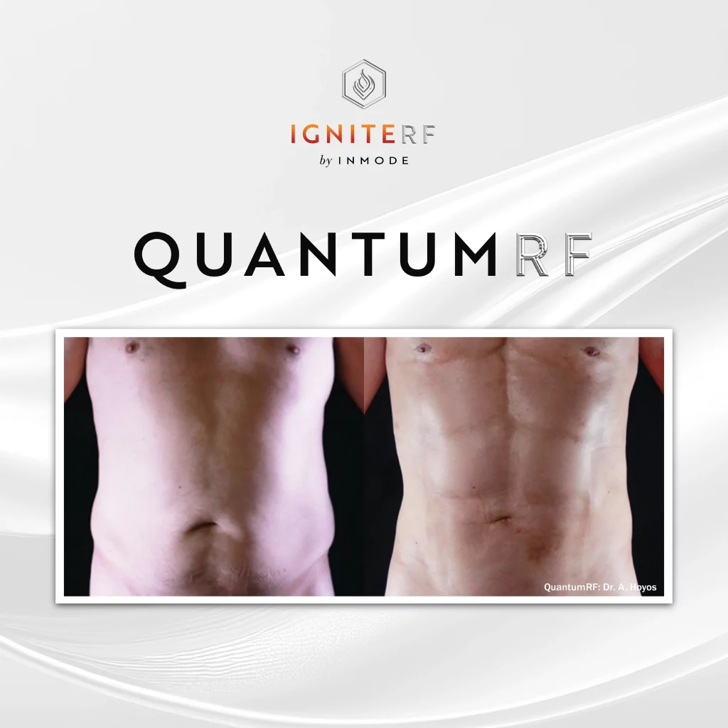Quantum Face + Body Sculpting Before and After1