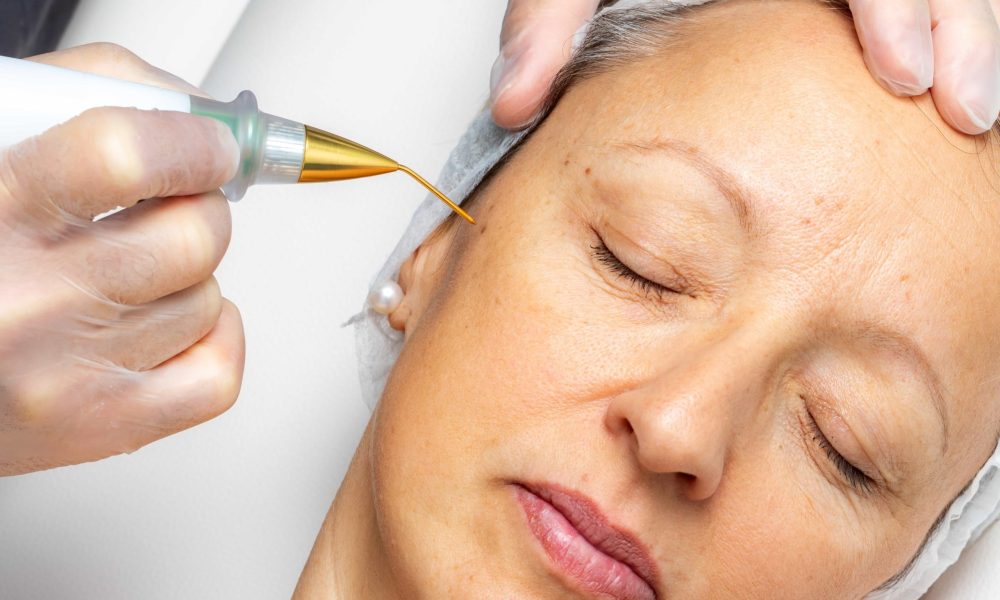 Subnovii Plasma Pen Non-Surgical Skin Rejuvenation